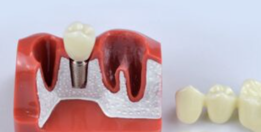 The Evolution of Dental Implant Materials
