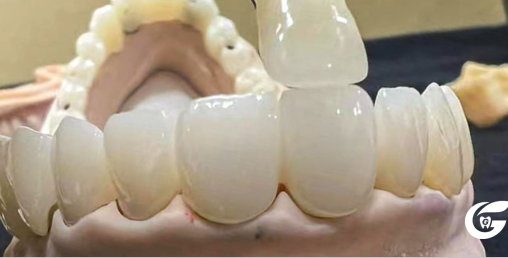 Why Zirconia Is The Best Material For Dental Restoration