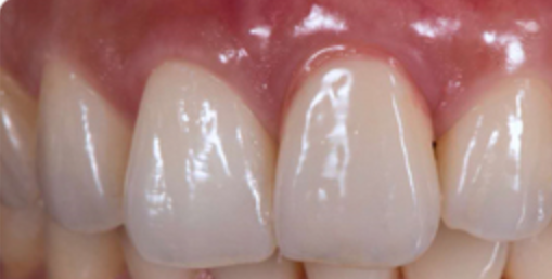 Zirconium Fixed Implant Bridge