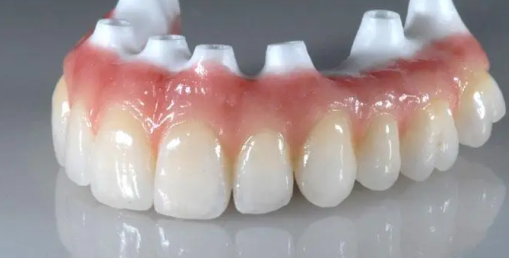 What is the Best Material to Use for My Dental Crown?