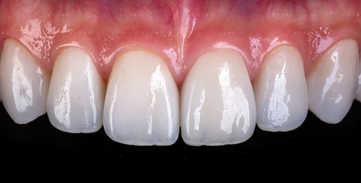 Clinical Application Of Lithium Disilicate Glass Ceramics