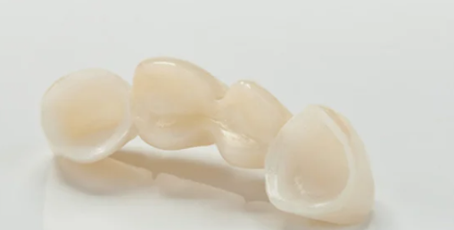 What Are the Benefits of a Dental Bridge?