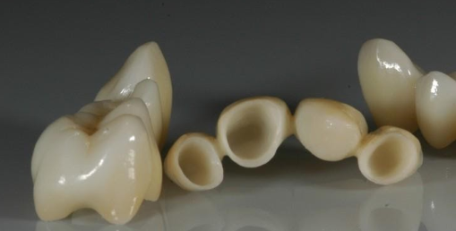 Common Questions About Dental Zirconia