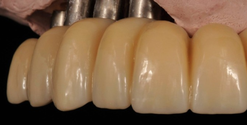 Bruxism and Zirconia