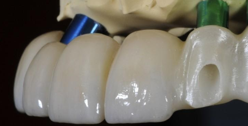 Reliability of zirconia restorations