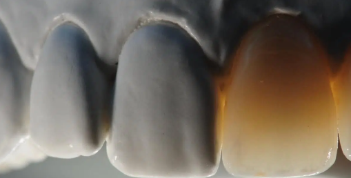 When To Use Zirconia For Dental implants?