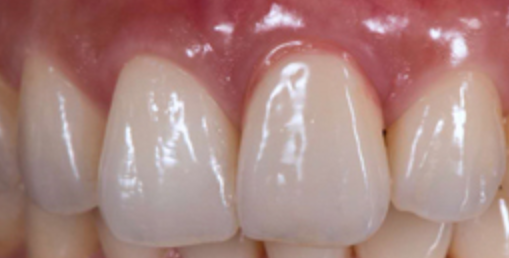 Why Do We Need Dental Crowns?