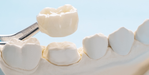 How Long Do Porcelain Veneers Last?