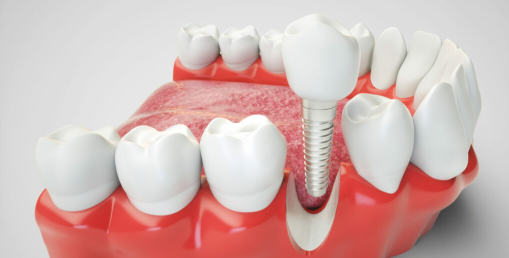 What are dental implants?