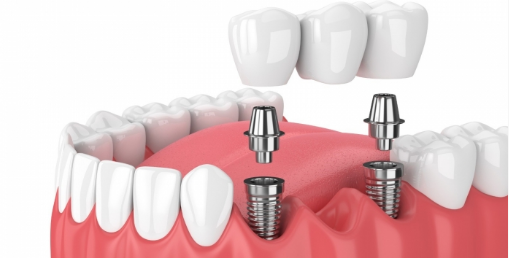What Affects The Lifespan Of Dental Implants?