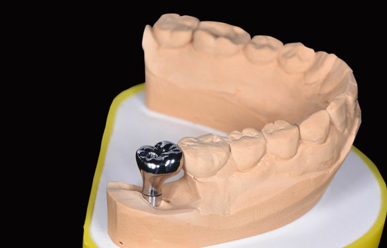 Implant Design Project